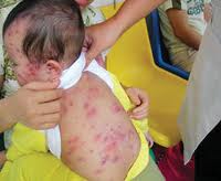Vaccination: Best measles prevention