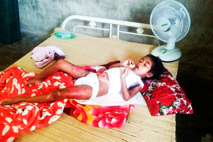 Eight-year-old girl badly burned